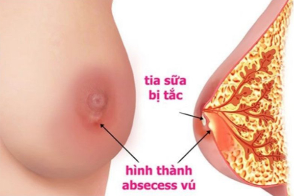 Phụ nữ sau sinh dễ bị áp xe ngực do tia sữa bị tắc