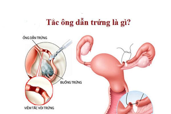 Viêm tắc vòi trứng ở nữ - Căn bệnh phụ khoa nguy hiểm
