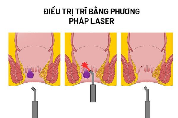 Cắt trĩ bằng laser là phương pháp loại bỏ búi trĩ tiên tiến 