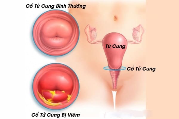 Viêm cổ tử cung là bệnh lý thường gặp ở phụ nữ trong độ tuổi sinh sản
