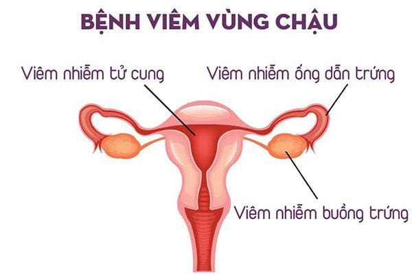 Viêm vùng chậu là bệnh lý xảy ra phổ biến ở nữ giới trong độ tuổi sinh sản