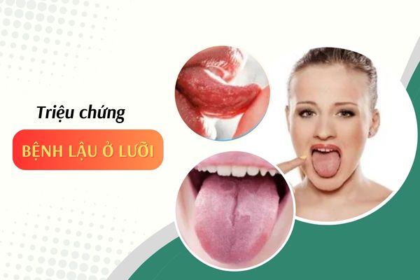 Dấu hiệu nhận biết bệnh lậu ở lưỡi