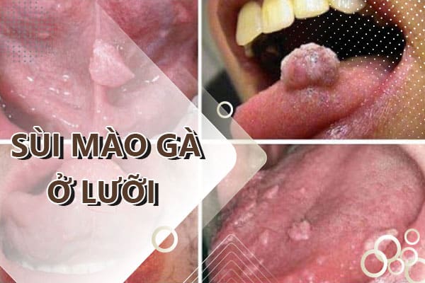 Sùi mào gà ở lưỡi: Nguyên nhân, triệu chứng và cách chữa trị