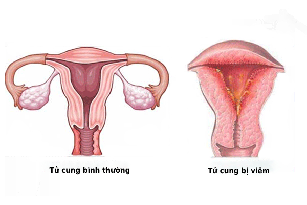 Viêm nội mạc tử cung gây ảnh hưởng đến sức khoẻ và khả năng sinh sản của phái nữ