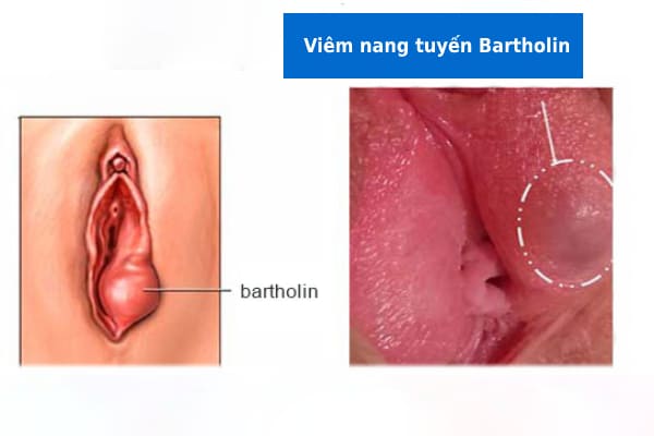 Bóc nang tuyến bartholin có ảnh hưởng gì không?