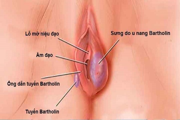 Bệnh viêm nang tuyến Bartholin gây ảnh hưởng đến sức khỏe của nữ giới