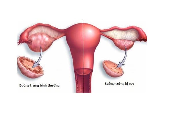 Suy buồng trứng là nguyên nhân dẫn đến vô sinh ở nữ giới