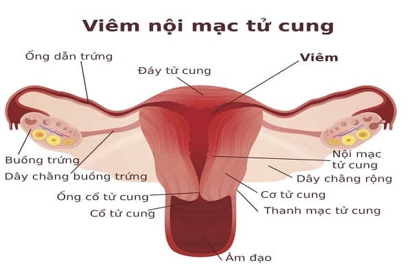 Viêm nội mạc tử cung là bệnh lý phụ khoa phổ biến ở nữ giới hiện nay