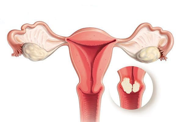 Nữ giới bị polyp cổ tử cung dễ gây ảnh hưởng khả năng sinh sản