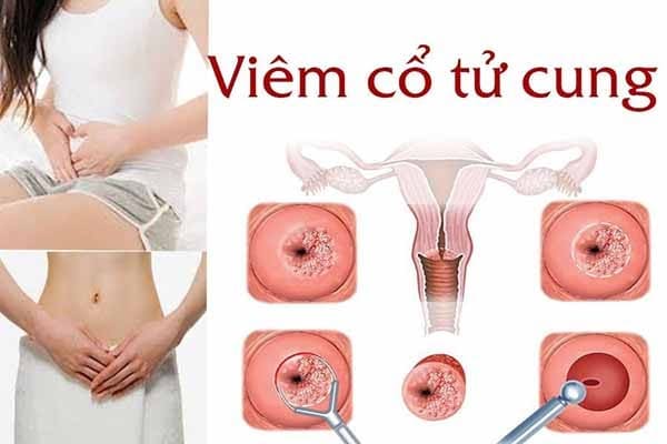 Viêm cổ tử cung là bệnh lý ảnh hưởng đến khả năng sinh sản của phụ nữ