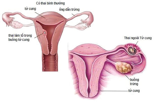Viêm buồng trứng là nguyên nhân dẫn đến bệnh vô sinh ở nữ giới
