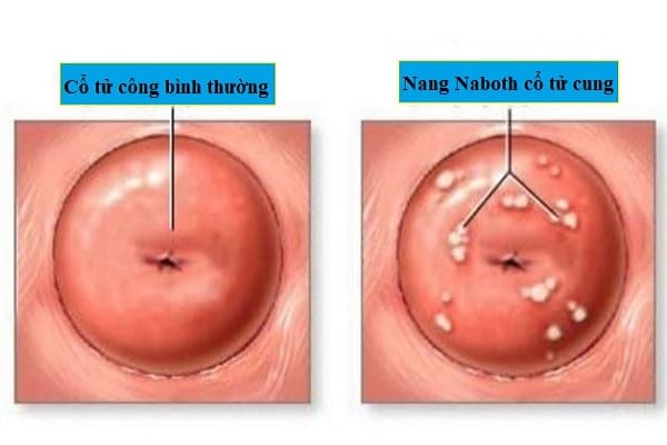 Nang Naboth cổ tử cung là căn bệnh phụ khoa lành tính