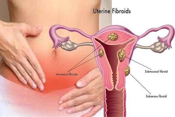 U xơ tử cung là bệnh lý xảy ra chủ yếu ở nữ giới trong độ tuổi sinh sản