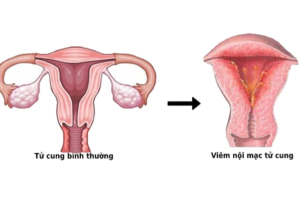 Viêm nội mạc tử cung là bệnh lý phụ khoa phổ biến ở phụ nữ hiện nay