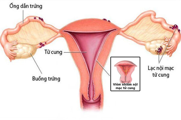 Viêm nội mạc tử cung là bệnh phụ khoa phổ biến ở phụ nữ hiện nay