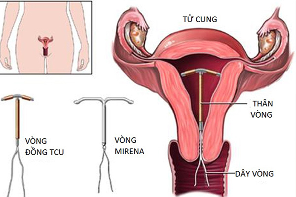 Hình ảnh vòng tránh thai đặt trong buồng tử cung phụ nữ