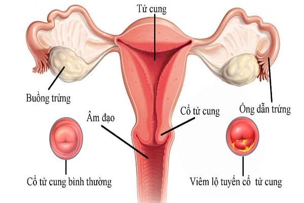 Dấu hiệu nhận biết bệnh viêm lộ tuyến cổ tử cung
