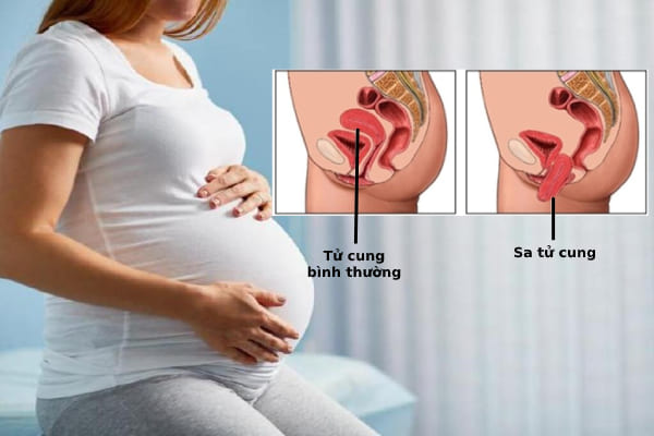 Dựa vào tình trạng của bệnh sa tử cung mà bác sĩ sẽ áp dụng liệu pháp điều trị phù hợp cho thai phụ