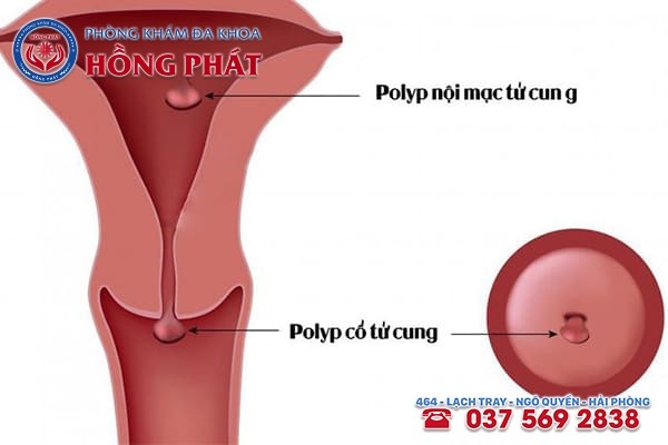 Có nhiều nguyên nhân dẫn đến bệnh polyp cổ tử cung