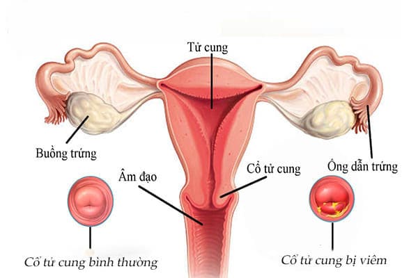 Bệnh viêm cổ tử cung ở nữ giới