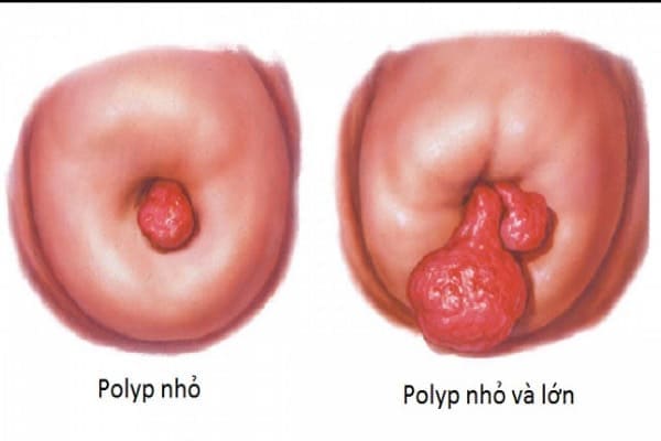 Đa số các polyp cổ tử cung là những khối u lành tính