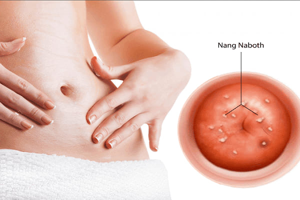 Nang Naboth là những khối u nhỏ có mủ xuất hiện trên bề mặt cổ tử cung