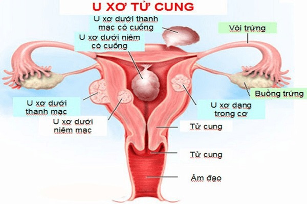 U xơ tử cung là bệnh lý phụ khoa xảy ra phổ biến ở phụ nữ hiện nay