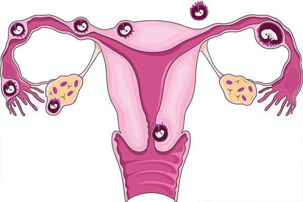 Hình ảnh mang thai ngoài tử cung ở chị em thai phụ