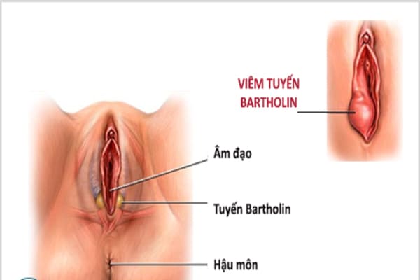 Viêm nang tuyến Bartholin là bệnh lý gây ảnh hưởng đến sức khoẻ và khả năng sinh sản của nữ giới