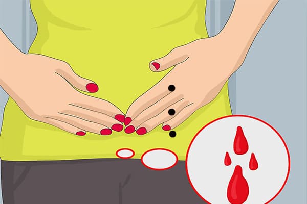 Có thai ngoài tử cung bị vỡ gây chảy máu ổ bụng đe dọa đến tính mạng người bệnh