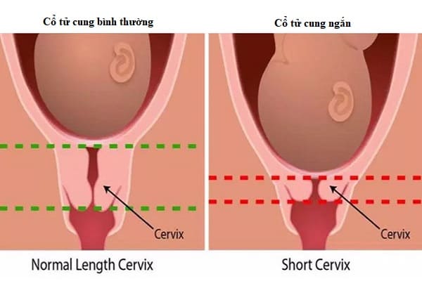 Cổ tử cung ngắn là nguyên nhân dẫn đến sinh non 