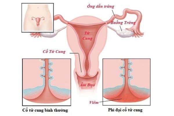Phì đại cổ tử cung là nguyên nhân dẫn đến vô sinh ở nữ giới