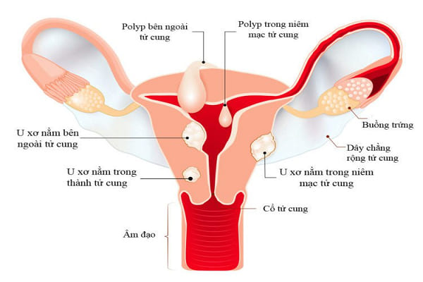 U xơ tử cung là bệnh lý phụ khoa phổ biến ở nữ giới 