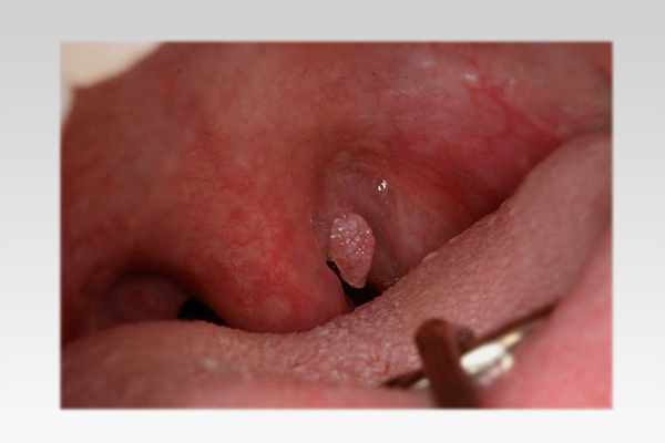 Nổi hột đỏ ở cuống lưỡi có thể là dấu hiệu của bệnh sùi mào gà nguy hiểm