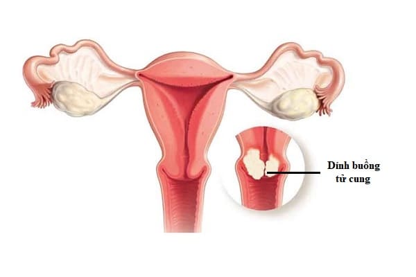 Dính buồng tử cung là căn bệnh gây cản trở hoạt động sinh dục ở nữ giới