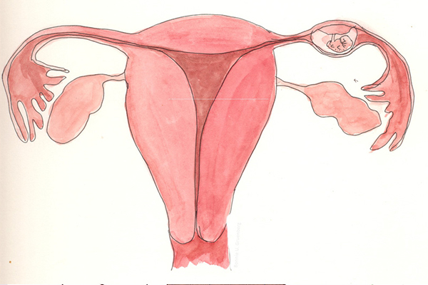 Hình ảnh minh họa thai ngoài tử cung