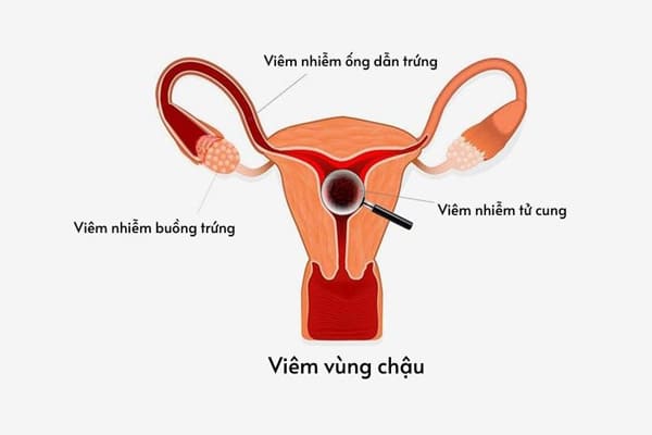 Hình ảnh về bệnh viêm vùng chậu ở nữ giới