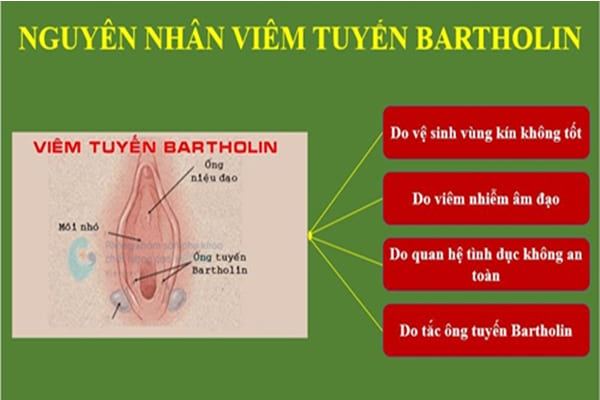 Nguyên nhân gây bệnh viêm nang tuyến bartholin