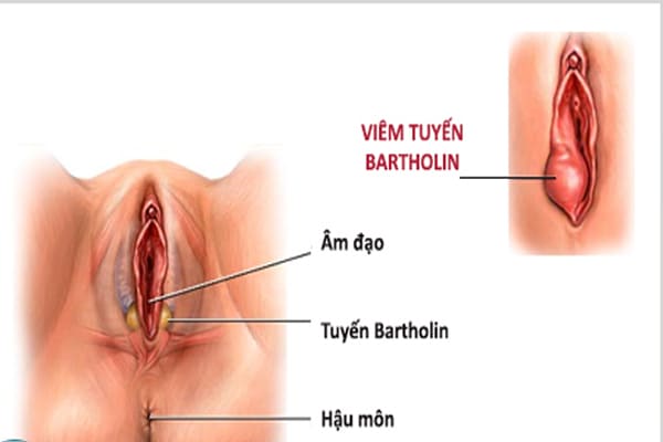 Hiểu về tình trạng viêm nang tuyến bartholin là gì?