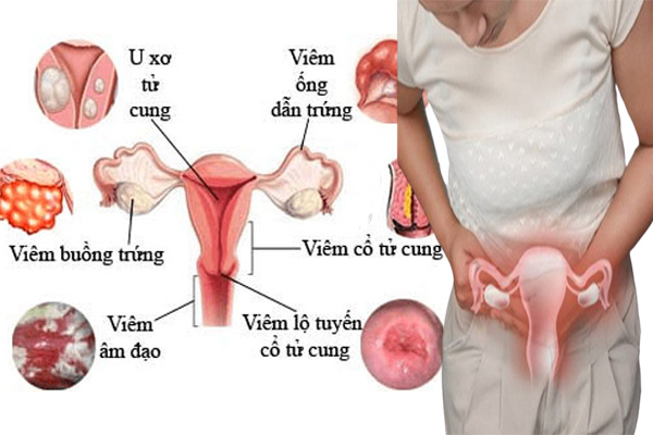 Một số căn bệnh phụ khoa thường gặp ở nữ giới