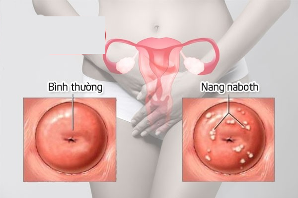 Bệnh nang Naboth cổ tử cung ở nữ giới