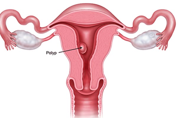Hình ảnh bệnh polyp cổ tử cung