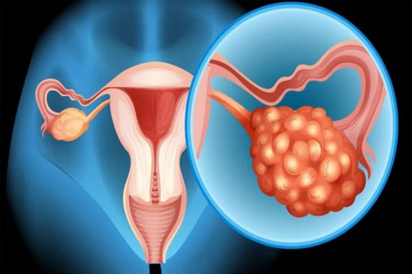 Hình ảnh bệnh viêm buồng trứng ở nữ giới