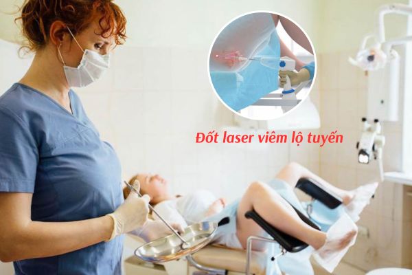 Đốt laser là phương pháp trị viêm lộ tuyến cổ tử cung hiệu quả