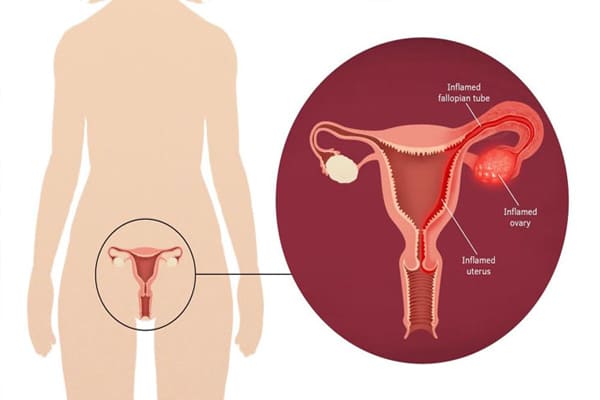 Viêm vùng chậu là tình trạng nhiễm trùng xảy ra ở vị trí đường sinh dục trên