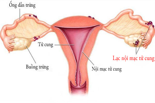 Bị đau bụng dưới sau khi quan hệ có thể là do nữ giới mắc bệnh lạc nội mạc tử cung