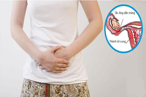 Đau bụng kéo dài là dấu hiệu điển hình bệnh viêm tắc vòi trứng