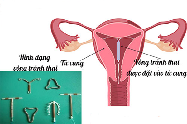 Hình ảnh các dạng vòng tránh thai