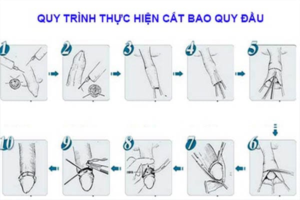 Quy trình thực hiện cắt bao quy đầu an toàn, đúng chuẩn tại Phòng Khám Việt Hải