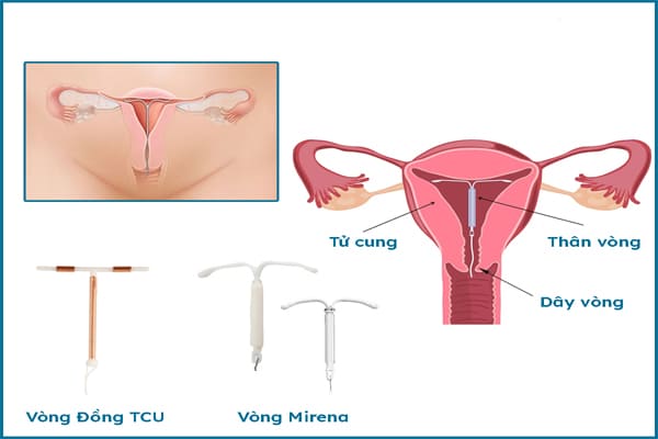 Hình ảnh về vòng tránh thai
